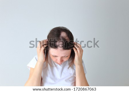 Real alopecia areata in a young girl. A bald head in a person. Diffuse alopecia. Androgenic alopecia. Hair loss. Bald spots on the head. Trichology Royalty-Free Stock Photo #1720867063