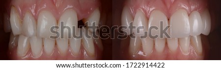 Dental all ceramic bridge before and after. Dental bridge prosthetic at front teeth to replace missing teeth. Royalty-Free Stock Photo #1722914422