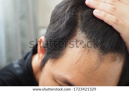 Young Asian man using his hand slicking his hair back after facing hair loss problem by taking medicine like zinc and biotin to make his hair grow faster and thicker Men health and medical concept Royalty-Free Stock Photo #1723421329