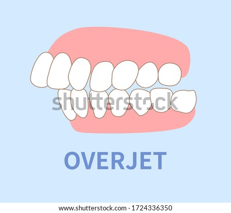  orthodontics  illustrations ; crowding, opposite occlusion, open bite, maxillary anterior protrusion, cavities, dentition, overjet Royalty-Free Stock Photo #1724336350