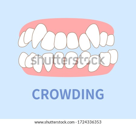  orthodontics  illustrations ; crowding, opposite occlusion, open bite, maxillary anterior protrusion, cavities, dentition Royalty-Free Stock Photo #1724336353