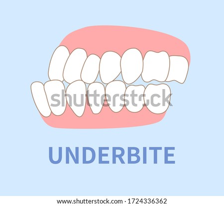  orthodontics  illustrations ; crowding, opposite occlusion, open bite, maxillary anterior protrusion, cavities, dentition, underbite