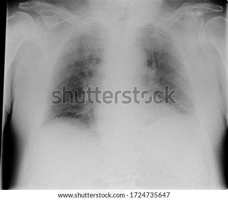 Posterior anterior chest x-ray showing signs of infiltration due to pneumonia