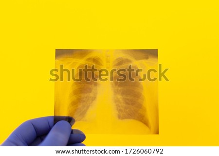 X-ray picture of a lung doctor holds a hand in a medical glove on a yellow background