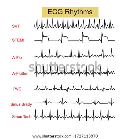 Tachycardia-wave Stock Vector Images - Avopix.com