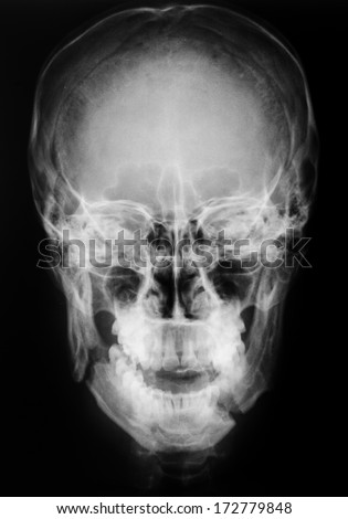 X-ray, skull, Fracture mandible