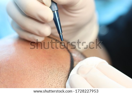 HAIR TRANSPLANT - FUE - DHI - SAPPPHIRE TECHNIQUES Royalty-Free Stock Photo #1728227953