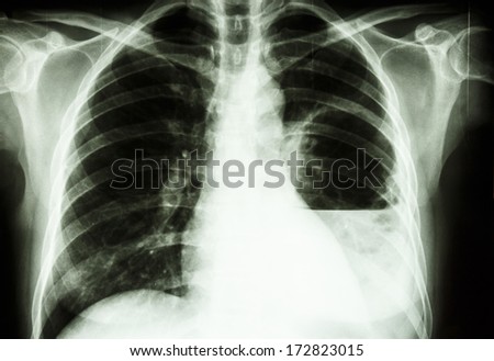 film X-ray show left lung abscess from Burkholderia pseudomallei infection (Mellioidosis)