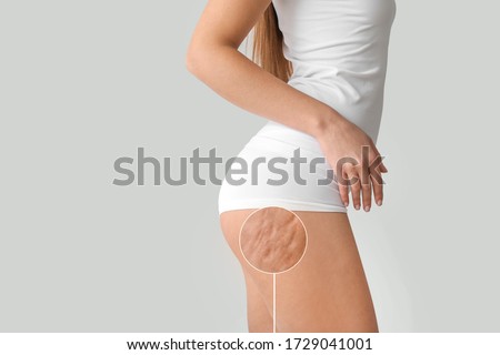 Young woman with cellulite problem on light background Royalty-Free Stock Photo #1729041001