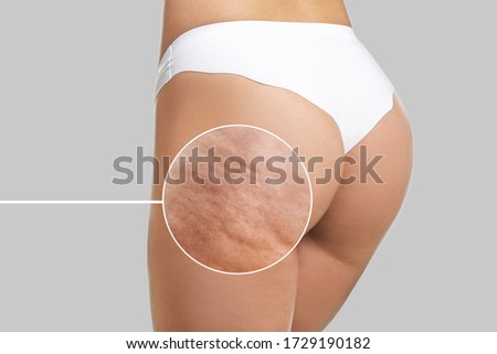 Young woman with cellulite problem on light background Royalty-Free Stock Photo #1729190182
