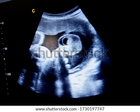 one sided hydrocele testis in fetus  by ultrasound Royalty-Free Stock Photo #1730197747