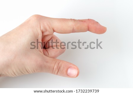 cut index finger with a extensor tendon injury, mallet finger, tip of the finger bending downwards while the rest of the finger stay straight, deformity in the last phalangeal bone, pointing direction Royalty-Free Stock Photo #1732239739