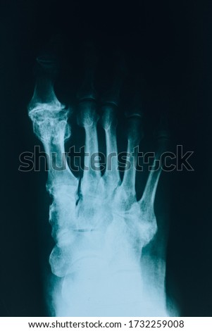 X-ray foot. X-ray picture of human foot