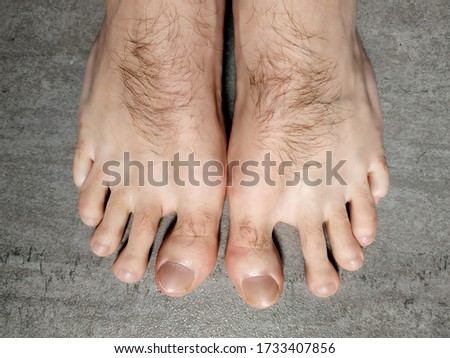 Hallux Valgus man with hairy  toe and foot