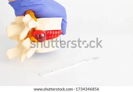 A model of the spine with an intervertebral hernia next to which lies a surgical scalpel. The concept of modern surgical operations for hernia of the spine, laminectomy and microdisectomy, copy space Royalty-Free Stock Photo #1734346856