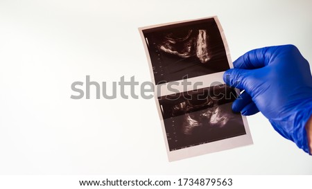Transrectal ultrasound of the prostate.The doctor examines the patient by x-ray.Analysis of the image of the prostate gland,close-up. Royalty-Free Stock Photo #1734879563