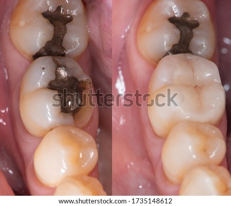 Dental collage, closeup of teeth before and after dental ceramic onlay treatment. Royalty-Free Stock Photo #1735148612