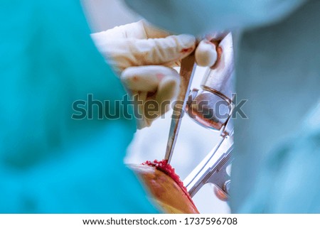 Close up photo of oscillating saw inside orthopaedic operating room. The saw was use in bone cutting process with motion blurred from slow speed shutter. Total knee replacement therapy in arthritis.