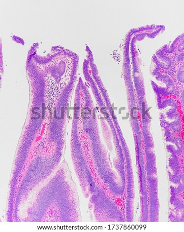 Superficial portion of villous adenoma (colonic polyp). This photo reveals lower power view of villous architecture. Royalty-Free Stock Photo #1737860099