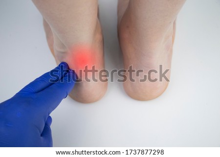 An orthopedic doctor examines a woman's leg. Achilles tendon and ankle diseases. Inflammation of the heel and foot, achillobursitis and achillotomy, rheumatism, tendon rupture Royalty-Free Stock Photo #1737877298