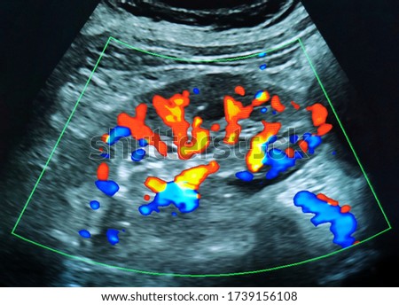 Closeup monitor of ultrasound machine showing normal human kidney with renal vascular flow in red and blue colors.