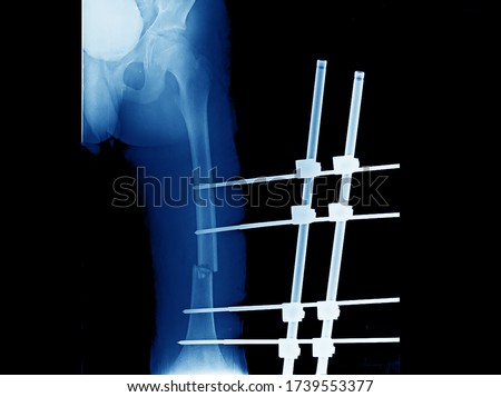 A plain x-ray of femur showing open fracture of femur that treated by external fixation. The fracture needs internal fixation with an implant when patient has stable vital signs.
