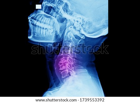 Lateral projection x-ray of cervical spine showing cervical spondylosis at multiple levels. This disease causes neck pain, radioculopathy and myelopathy.  Royalty-Free Stock Photo #1739553392