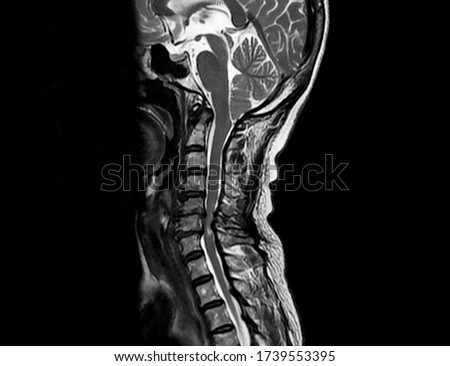 Sagittal view of magnetic resonance image of MRI of cervical spine showing cervical spondylotic myelopathy that causes neck pain and weakness. This patient needs operative treatment. Royalty-Free Stock Photo #1739553395