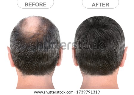 Back view of male head before and after hair extensions Royalty-Free Stock Photo #1739791319