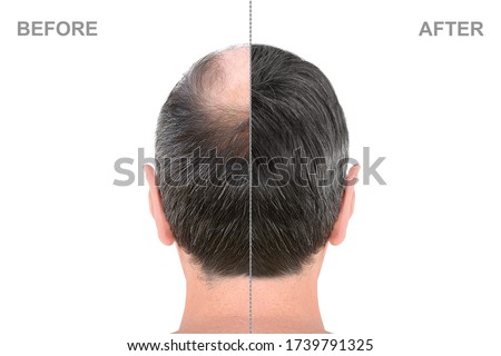 Back view of male head before and after hair extensions Royalty-Free Stock Photo #1739791325