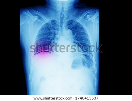 An x-ray of in a patient with severe dyspepsia showing radiographic sign of intra-abdominal air on right diaphragm. This is a peptic ulcer perforation sign. The patient needs exploratory laparotomy.