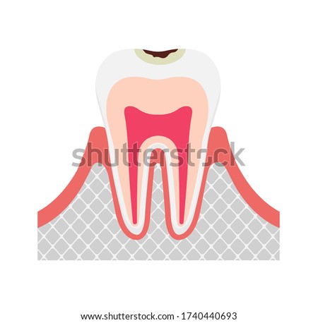 The stage of tooth decay. Decay in enamel