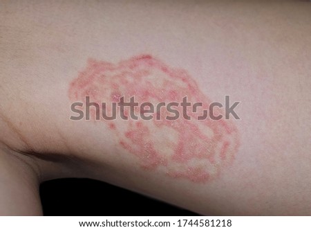 Tinea Corporis or Fungal Infection on thigh of Southeast Asian, Burmese child. It is a superficial dermatophyte infection. Isolated on black background. Royalty-Free Stock Photo #1744581218