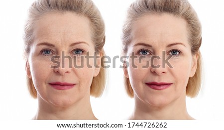 Middle age close up woman face before after cosmetic procedures. Skin care for wrinkled face. Before-after anti-aging facelift treatment. Facial skincare and contouring.  Royalty-Free Stock Photo #1744726262