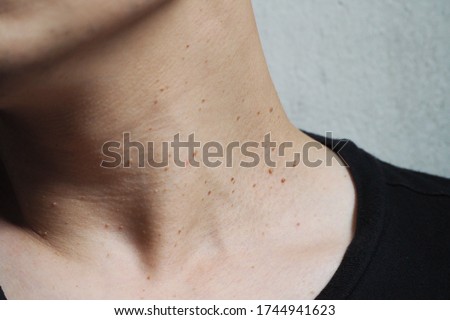 Many skin tags or Acrochordon on the neck of an Asian male. They are small soft and common benign on the human skin especially on adult skin and can be irritated by shaving and daily clothing Royalty-Free Stock Photo #1744941623