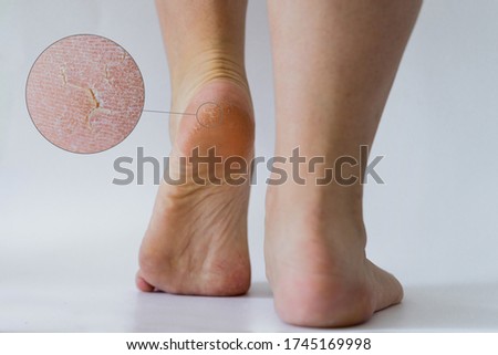 Cracked woman heel with close up of the crack. Severe crack running diagonally with further deep cracks and dry flaky skin.  Royalty-Free Stock Photo #1745169998