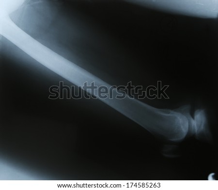 Roentgen shot of thigh bone