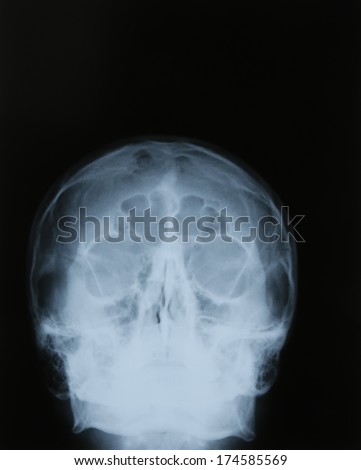 Roentgen shot of skull