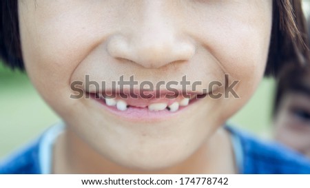 little girl mouth smiling and broken teeth