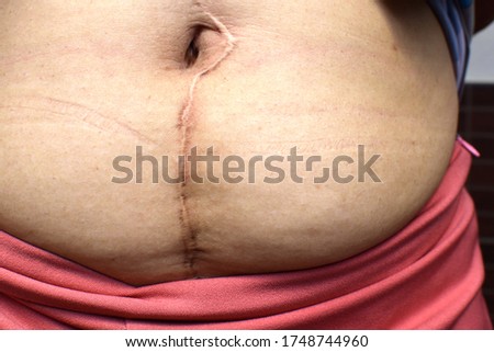 Close-up  Of the scar on the abdomen from surgery