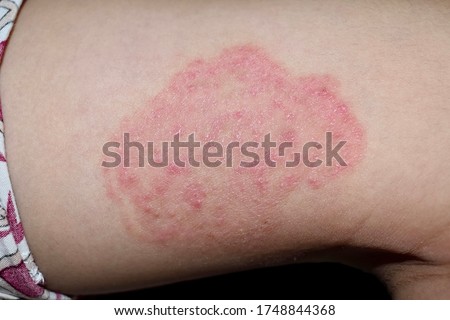 Tinea Corporis or Fungal Infection on thigh of Southeast Asian, Burmese little boy. It is a superficial dermatophyte infection. Isolated on black background. Royalty-Free Stock Photo #1748844368