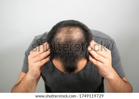 sparse hair and bald head problem on a grey background
 Royalty-Free Stock Photo #1749119729