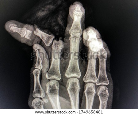 Open fracture of index finger with joint dislocation , injury at work