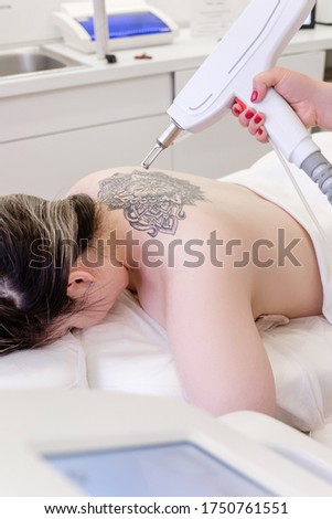 Top view hand of a beautician holds a laser device over a tattooed back of a girl to remove an unwanted tattoo. Concept of erasing tattoos as expensive procedure in beauty parlor modern vedical clinic Royalty-Free Stock Photo #1750761551