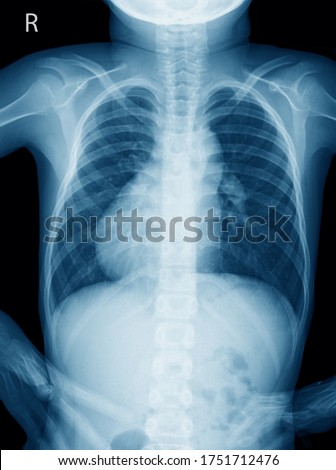 Chest X ray of a 11 year old boy with dextrocardia situs inversus showing the cardiac apex pointing towards right, Other congenital malformations of heart - Dextrocardia Royalty-Free Stock Photo #1751712476