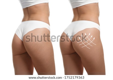 Young woman in underwear before and after plastic surgery on white background Royalty-Free Stock Photo #1752179363