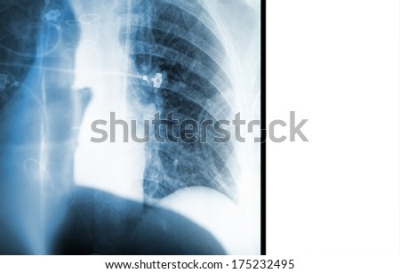 X-ray picture of lungs and a silhouette of a doctor.