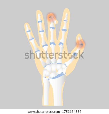 bone of the hand anatomy, internal organs body part orthopedic health care, trigger finger concept, vector illustration cartoon flat character design clip art