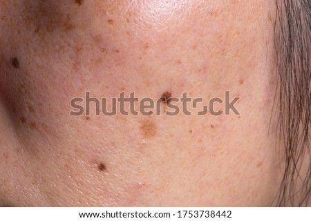 Close-up of spots and blackheads on the face of women Skin care Royalty-Free Stock Photo #1753738442
