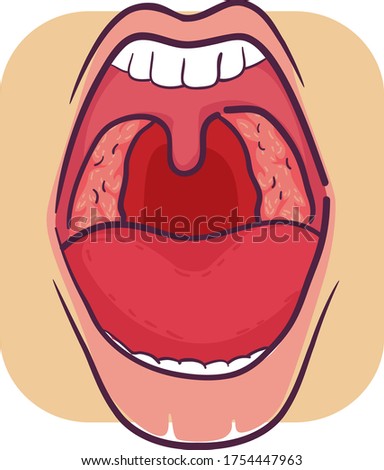 Illustration of Wide Opened Mouth with Inflamed Tonsils, Symptom of Tonsillitis